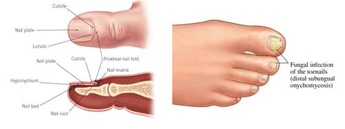 Признаки грибка ногтей